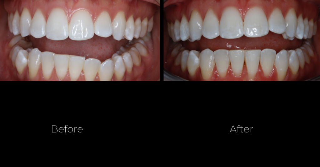 The outstanding result of Clear Smile Aligners Therapy