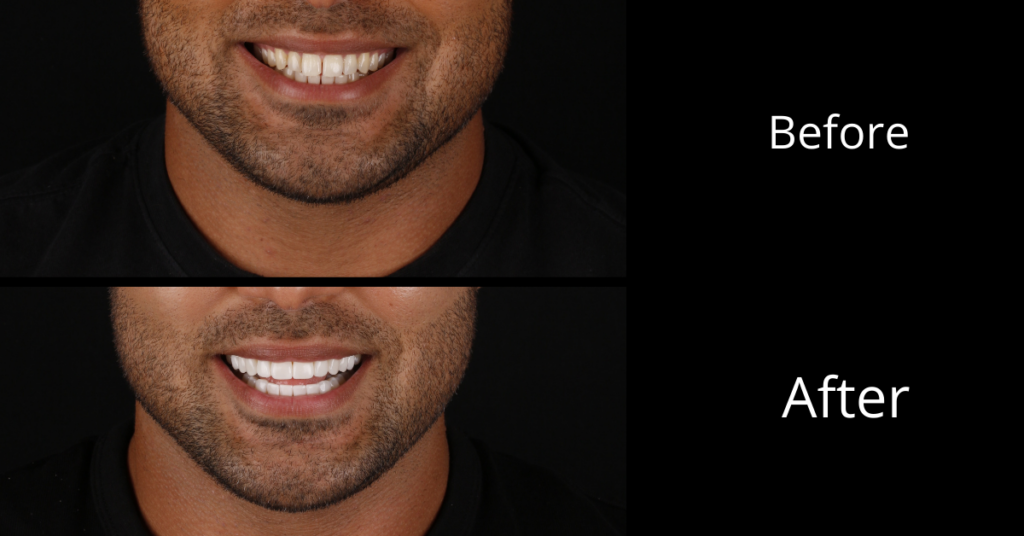 Dr Sheryl Smithies completed his composite veneer smile rehabilitation