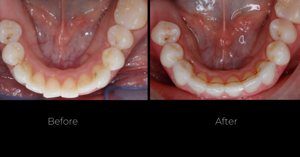 Before and After Clear Aligners Therapy