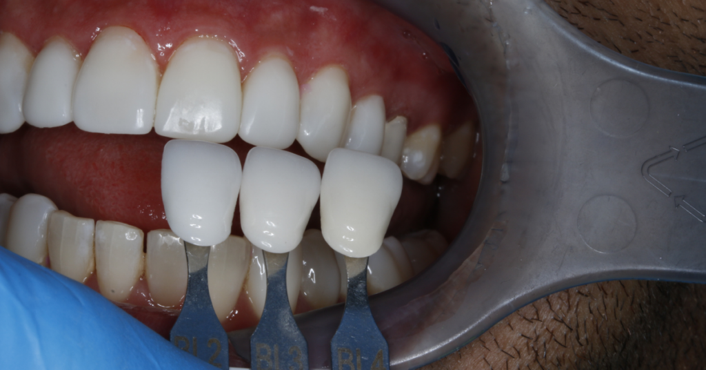 Guide match to help determine the shade of veneer to use