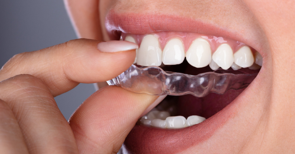 What is Clear Aligner therapy?