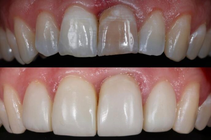 Composite-Veneers-Before-After
