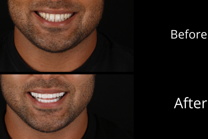 Composite Veneers